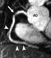 IJC 2013 Anomalous coronary artery origins Calcified Plaques 27