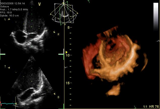 3D Echocardiogram