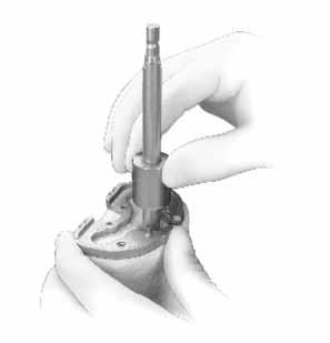 Zimmer NexGen Tibial Stem Extension & Augmentation Surgical Technique 5 Pin the Tibial Cutting Guide to the tibia securely and use a oscillating saw with a 0.050 blade to cut through the slots (Fig.
