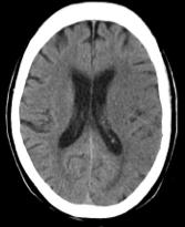 Ischemic stroke Not obvious on CT in a few hours