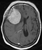 Meningioma The most common extraaxial tumor 90% benign Typical imaging finding Isointensities