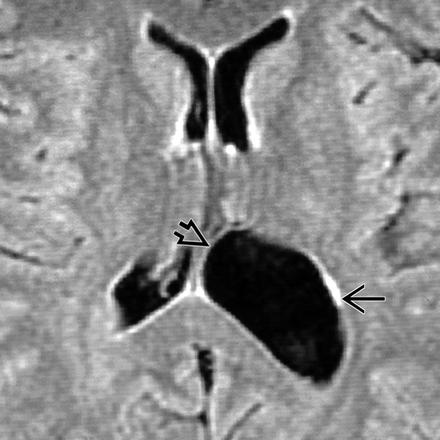 Ependymal cyst benign, ependymal-lined cysts of the lateral ventricle or juxtaventricular region of