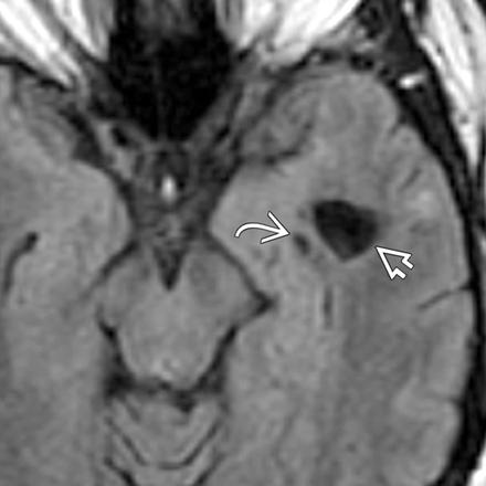 Neuroglial cyst Congenital benign epitheliallined lesions that occur anywhere in the neuraxis < 1% of intracranial cysts Most typical in
