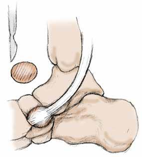 3 Step Three The posterior tibial tendon is released and any tendinopathic tissue is removed.