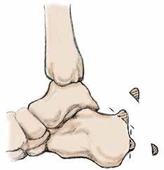 5 The posterior aspect of the calcaneus is remodeled utilizing a reciprocating rasp so as not to leave a prominence, palpable under the skin, creating difficulties with