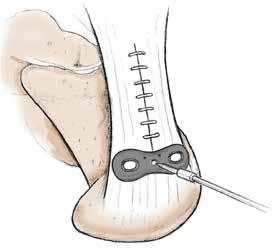 6 Step Six Next, with the Achilles tendon at the desired insertion point on the calcaneous, the Tendon Anchor System is placed over the tendon and temporarily secured