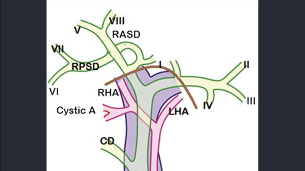 CHA ühine maksaarter RHA parem maksaarter LHA vasak maksaarter GDA gastroduodenaalarter PSPDA
