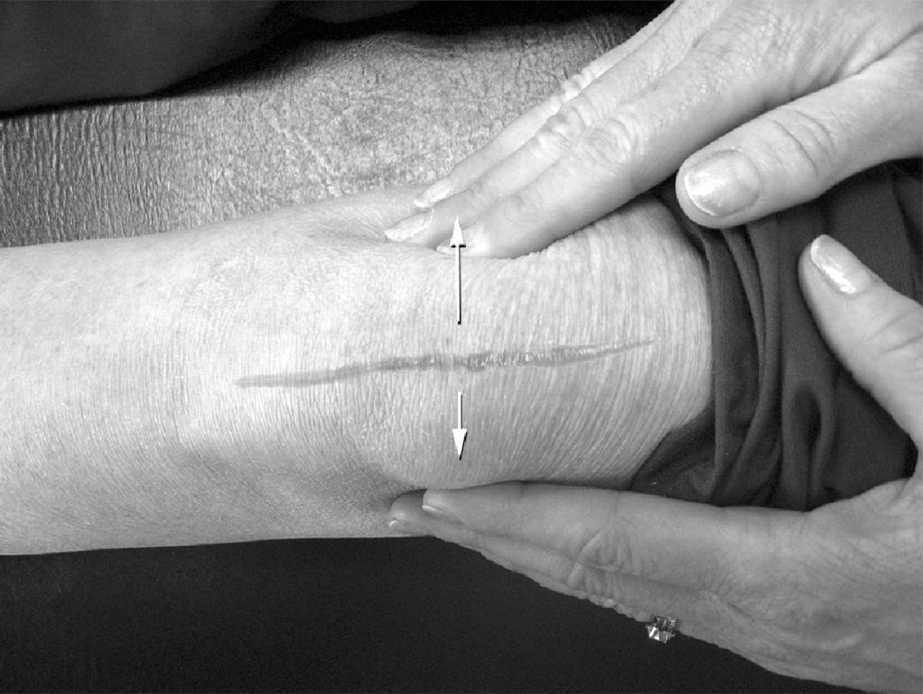 Patellar Mobilizations Begin after staple removal, when your incision is stable. Grasp the kneecap with fingers resting on both the inside and outside border of the kneecap.