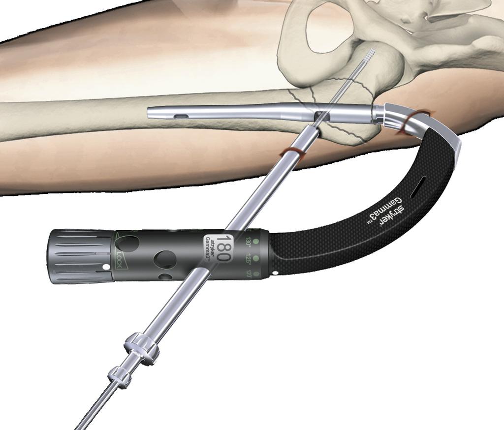 Lateral View Frontal View Instrument features The Fragment Control Clip is made from