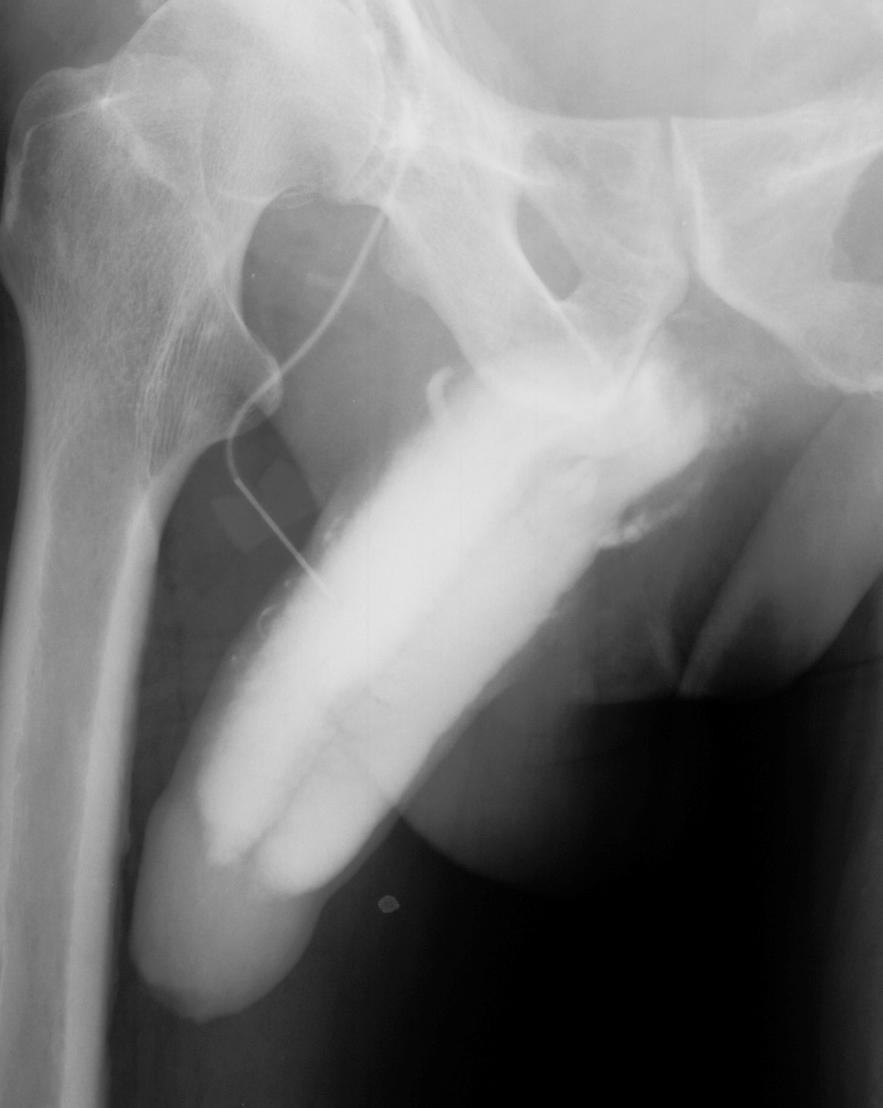 Patient showing absence of venous leakage evidenced by cavernosography in