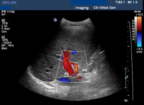 Color Doppler Hepatic artery runs parallel with the portal
