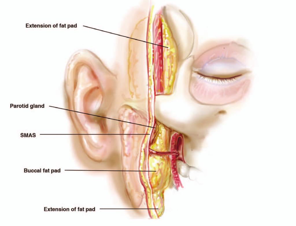 Parotid gland SMS uccal fat pad Temporalis m. Zygomatic arch uccinator m.