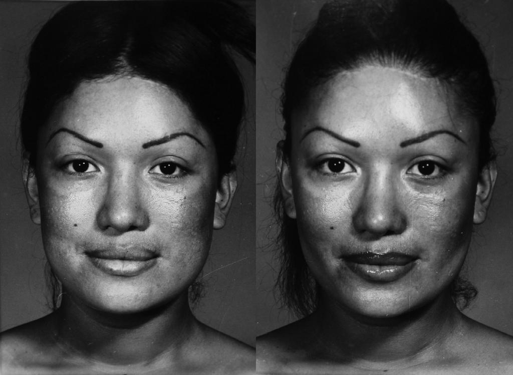 Figure 7., Preoperative view of a 74-year-old woman with buccal lipodystrophy.