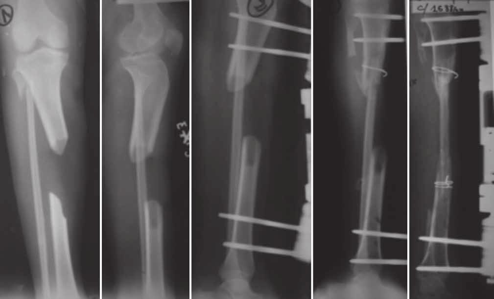 treatment of large diaphyseal bone defect of the tibia 19 A B C D E Fig. 1. 20-year-old girl who sustained a traffic trauma with loss of 10 cm of tibial diaphysis. A and B : initial radiograph.