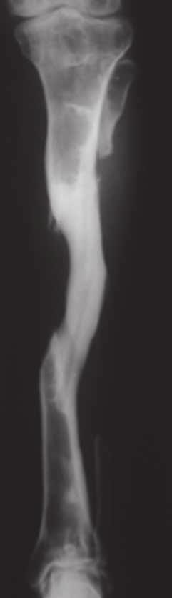 treatment of large diaphyseal bone defect of the tibia 21 Fig. 3.