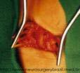 7. Operativni tretman kod sindroma karpalnog kanala Kirurško oslobađanje široke četvrtaste sveze (Slike 14. i 15.