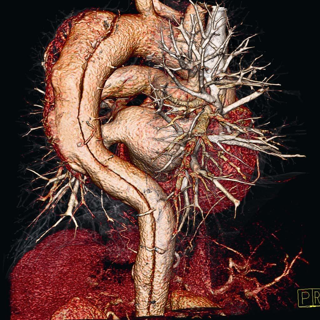 CT angiography Aortic
