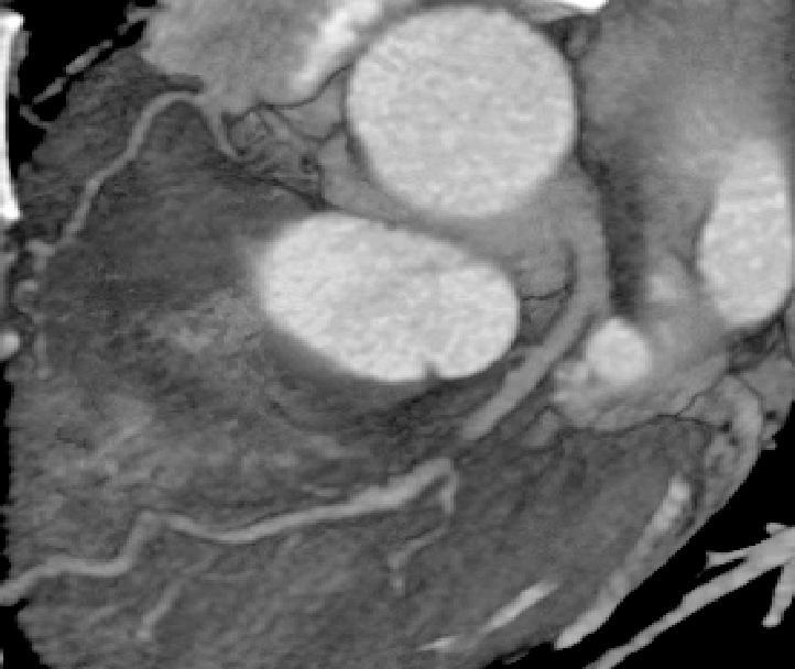 Cardiac CT Angiography CT angiography 62 year old male with