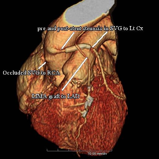 (CABG : LIMA TO LAD, SVG to LCx, RCA