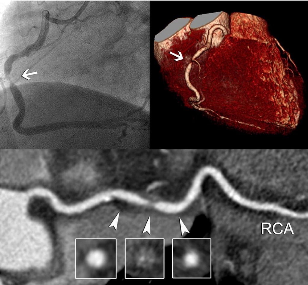 A High-Grade Stenosis in the RCA Weustink, A. C. et al.