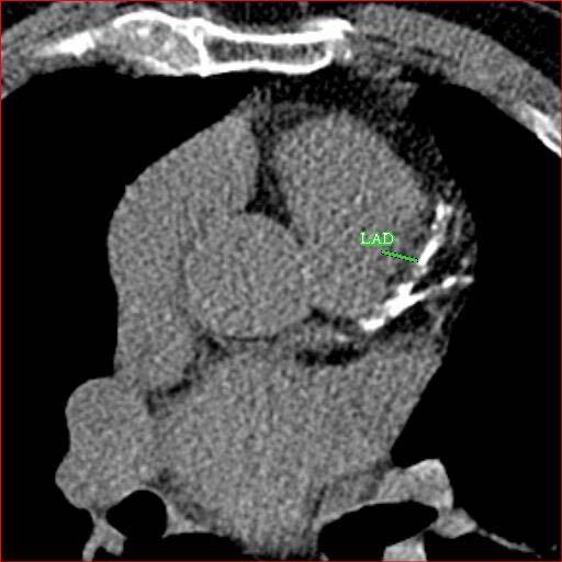Early detection of Coronary Artery Disease (CAD) Coronary Artery Calcium imaging using