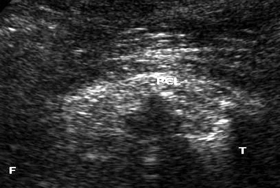 Figure 3A: Ultrasound image showing contused