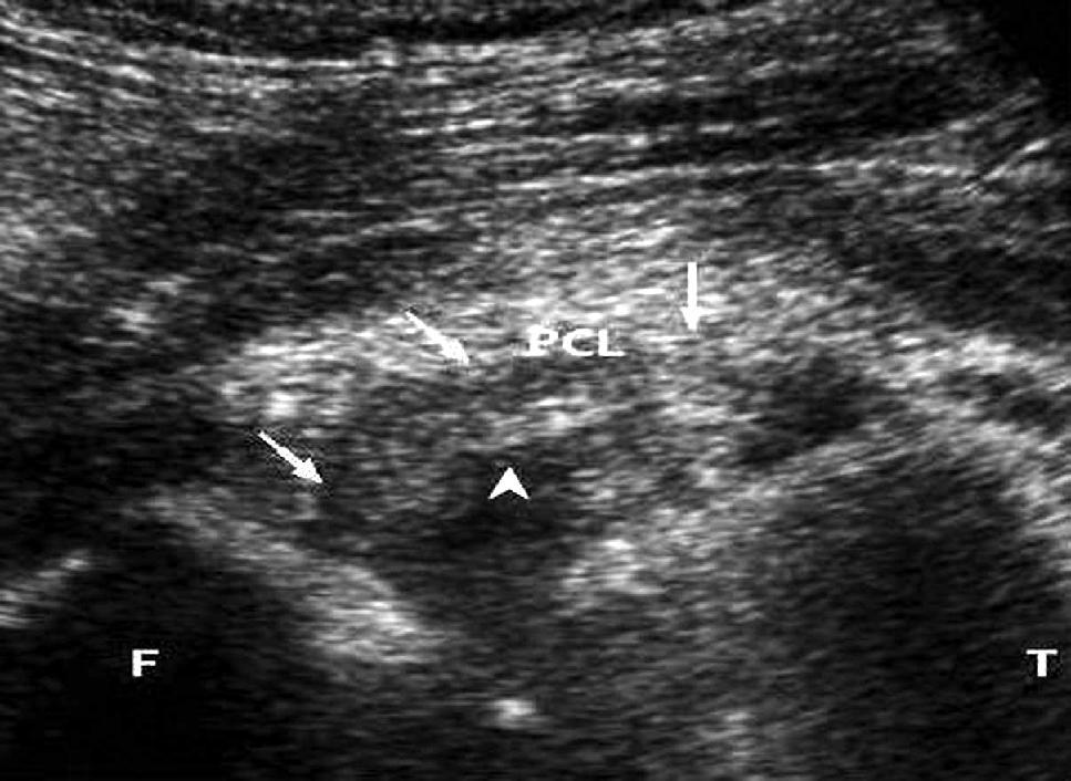 thickened PCL at femoral attachment (arrows).