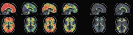 Amyloid PET Scans in Presymptomatic Early- Onset Alzheimer s Disease Gene Carriers Non-Carriers
