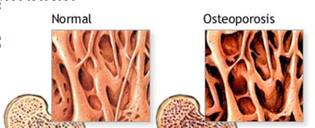 Osteoporosis Most common