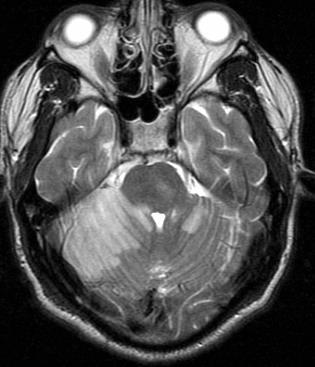 . CT MRI axial FLAIR MRI