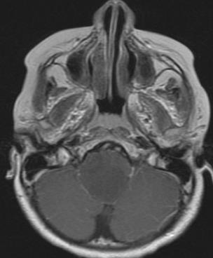 axial MRI T2WI