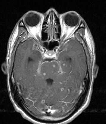 . axial MRI T1 contrast TB