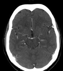 willis CT+ Anteriorly two cerebral peduncles separated
