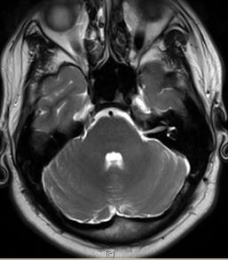 Pons.. MRI axial T2WI MRI Sagittal T1WI 2 3 p p 1 1 P pons 1