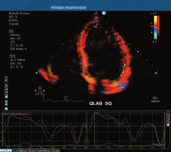Unlike some other systems that boast ease of use, the HD15 also offers the diagnostic capabilities you need to perform difficult, in-depth echo studies with advanced quantification.