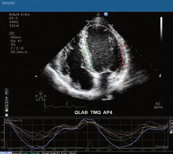 On-cart and off-cart access to Philips QLAB software, delivering automated and objective methods for quantifying echo and vascular data, including speckle-based Tissue Motion Quantification