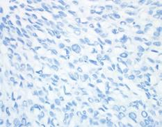 normal epithelium. The percentage of stained viable tumor cells in the specimen determines PD-L1 IHC 28-8 pharmdx result.