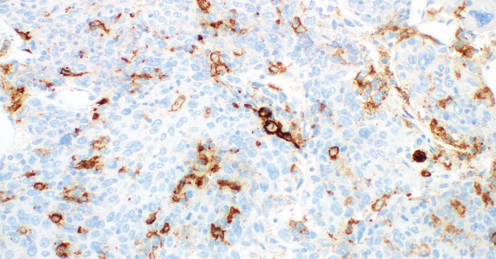 Figure 12: Urothelial carcinoma of the bladder showing strong staining of intra-tumoral associated immune cells (red arrows), while the tumor cells are
