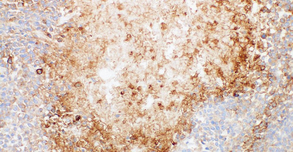 Figure 19: Urothelial carcinoma of the bladder. Note plasma membrane staining of foreign body giant cells (FBGC) (black arrows) next to tumor cells.