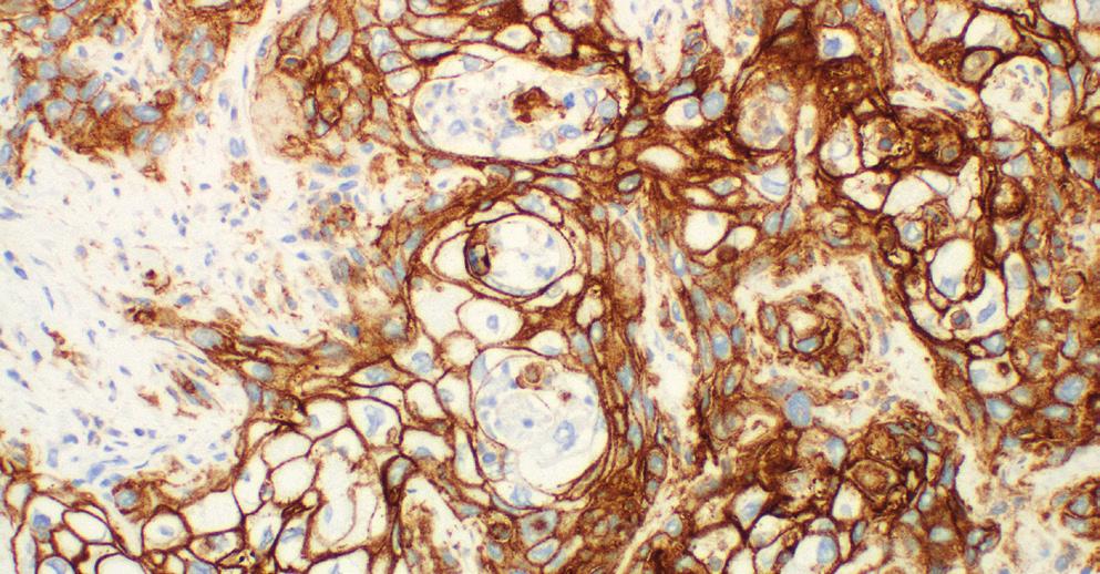 These FBGCs can be misidentified as tumor in the PD-L1 stained slide, but can be recognized as non-tumor in the H&E stained slide. Exclude FBGCs in the scoring of the tumor. 20x magnification.