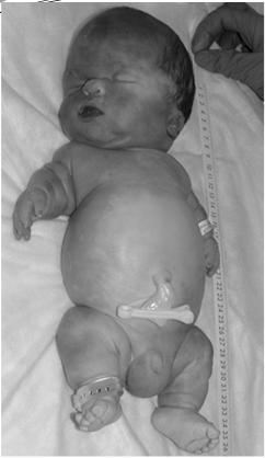 Dwarfism Most common lethal skeletal dysplasia in infancy Rhizomelia Disproportion in