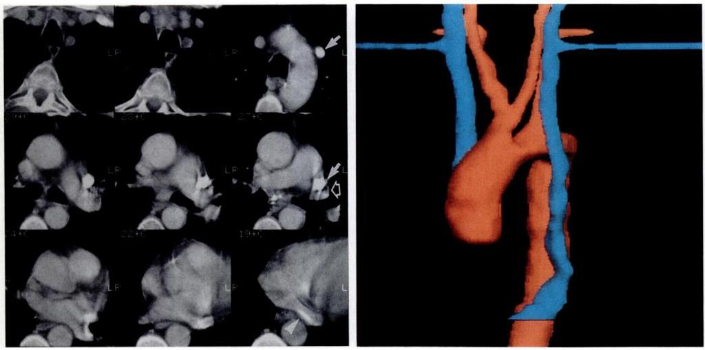 376 DILLON AND CAMPUTARO AJA:160, February 1993 lobe and duplication of the superior vena cava and provides guidelines for differentiating these anomalies.