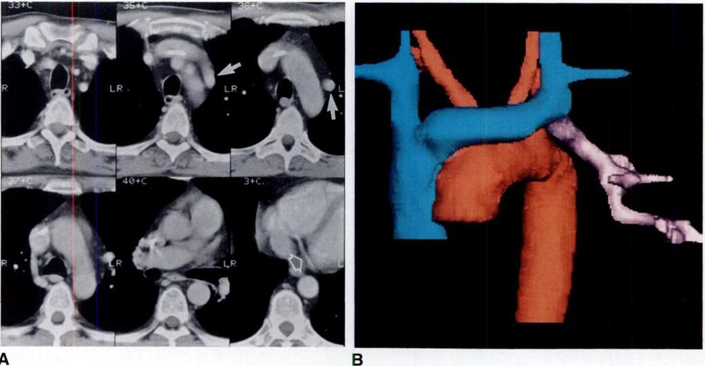 8 cm. No obvious signs of right ventricular abnormality were visible on any of the scans.