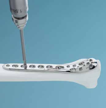 Screw Insertion Option: Articulated Tension Device Instrument 321.
