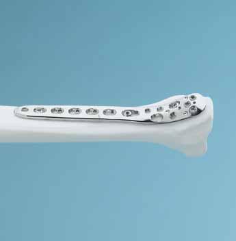 AO ASIF Principles Anatomic reduction Precontoured plate assists reduction of metaphysis to diaphysis and facilitates restoration of the articular surface by exact screw placement.