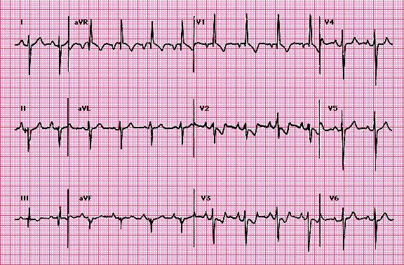 Most ECG signs are specific but not sensitive for the detection of right