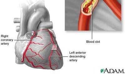 Excess Triglycerides- Life Applications: Cause plaque to build up Arteriosclerosis = walls of the arteries get