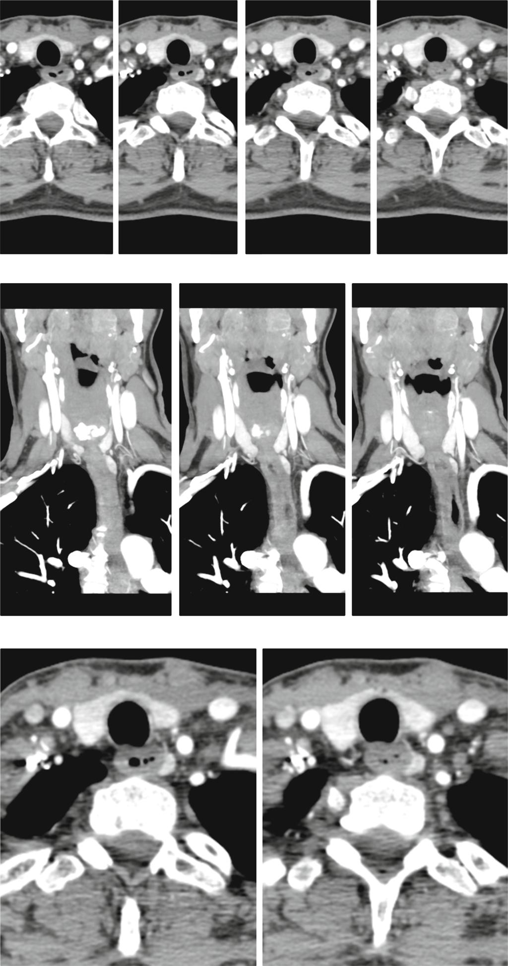 8 Fig. 2 a 4D-CT images of left paraesophageal parathyroid adenoma with feeding vessel. Arterial, 2 mm slices, adenoma measured 8 4 14 mm on CT (images supplied by Drs. Bart Clarke and Geoffrey B.