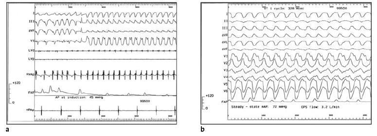 programmed ventricular stimulation Pacemapping in areas with long St-QRS and 12 morphology match