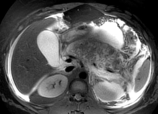 Findings of AP Swollen pancreas Abnormal